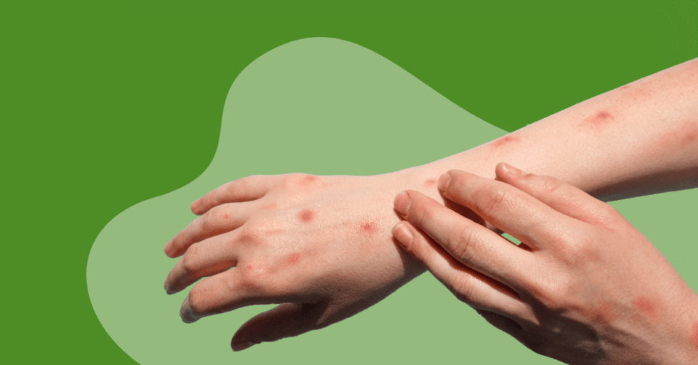 Does Monkeypox Leave Scars? Axiom Medical